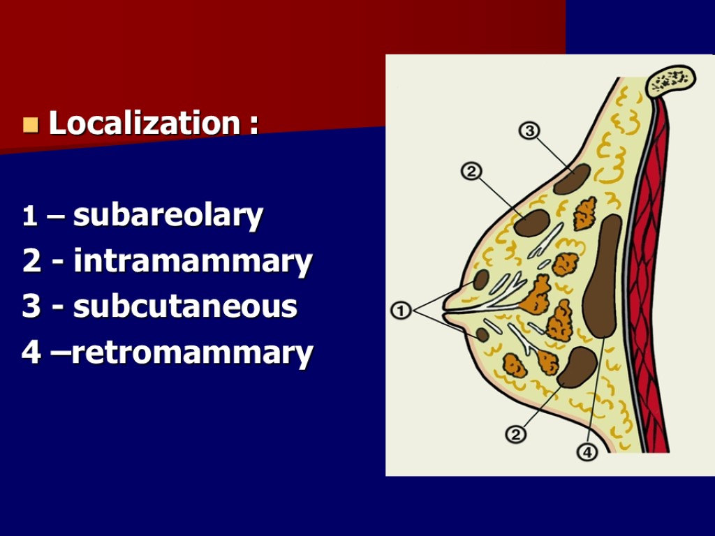 Localization : 1 – subareolary 2 - intramammary 3 - subcutaneous 4 –retromammary